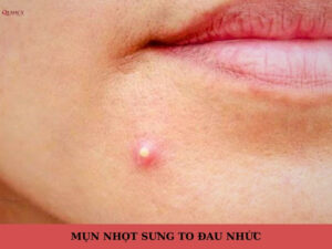 mụn nhọt sưng to đau nhức