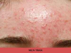 mụn trán