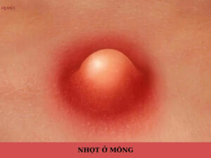 nhọt ở mông