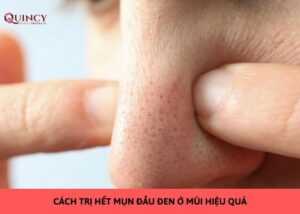 cách trị hết mụn đầu đen