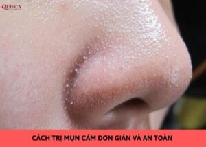 cách trị mụn cám
