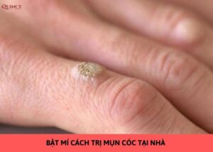 cách trị mụn cóc tại nhà
