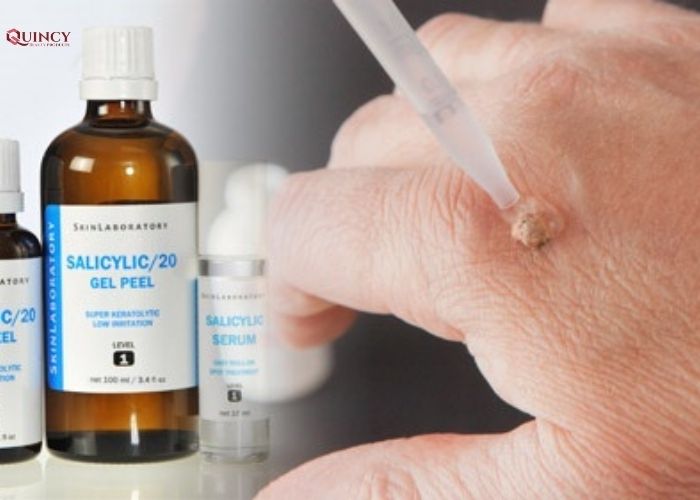 Bật mí cách trị mụn cóc tại nhà bạn không nên bỏ qua 18 cách trị mụn cóc tại nhà