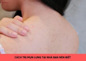 cách trị mụn lưng tại nhà