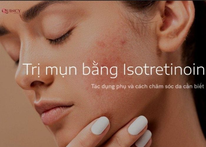 cách trị mụn trong 7 ngày