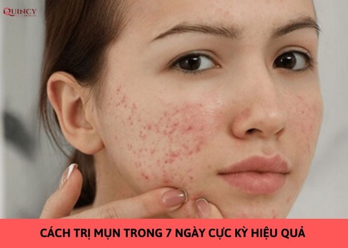 cách trị mụn trong 7 ngày