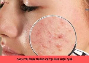 cách trị mụn trứng cá