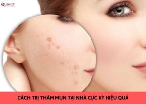 cách trị thâm mụn tại nhà