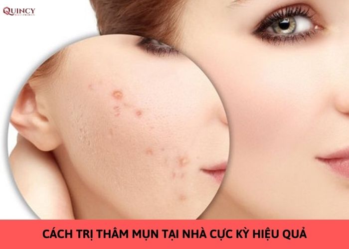 10 Cách trị thâm mụn tại nhà cực kỳ hiệu quả 11 cách trị thâm mụn tại nhà