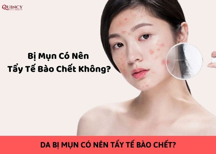 da bị mụn có nên tẩy tế bào chết