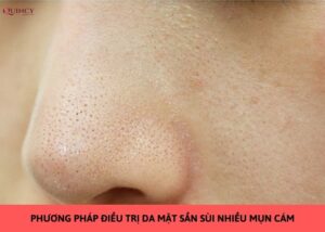 da mặt sần sùi nhiều mụn cám