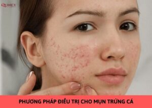 điều trị cho mụn trứng cá