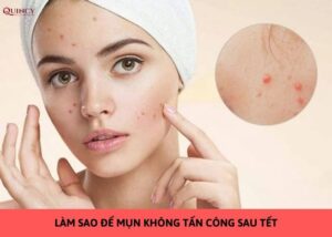 làm sao để mụn không tấn công sau tết