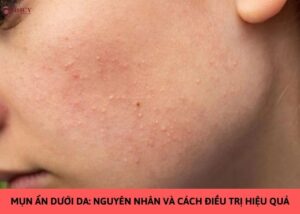 mụn ẩn dưới da