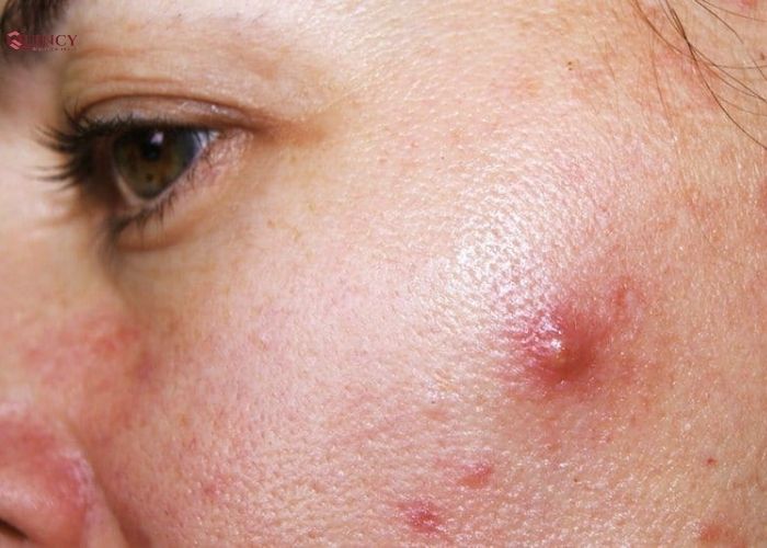 Mụn bọc ở má: Chia sẻ nguyên nhân và cách điều trị hiệu quả 6 mụn bọc ở má