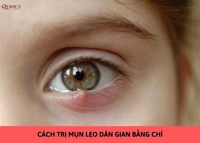 mụn lẹo