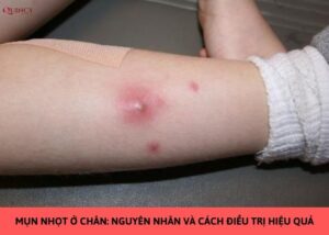 mụn nhọt ở chân