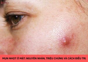 mụn nhọt ở mặt