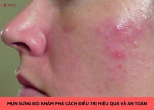 mụn sưng đỏ