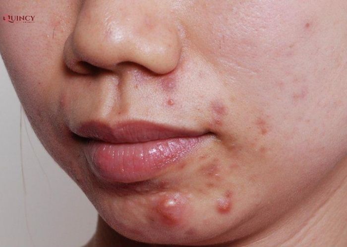 Mụn sưng đỏ: Khám phá cách điều trị hiệu quả và an toàn 9 mụn sưng đỏ