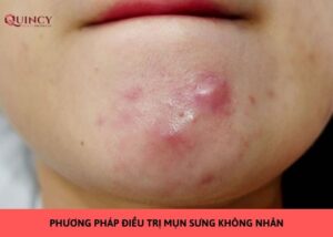 mụn sưng không nhân