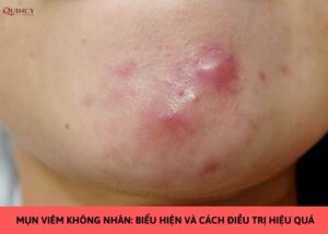 mụn viêm không nhân