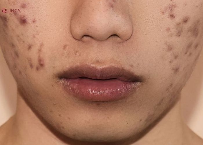 Nguyên nhân dẫn đến thâm sẹo do mụn gây ra 6 nguyên nhân dẫn đến thâm sẹo do mụn