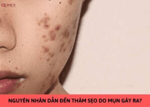 nguyên nhân dẫn đến thâm sẹo do mụn