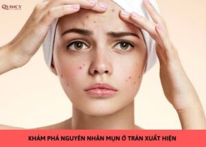 nguyên nhân mụn ở trán