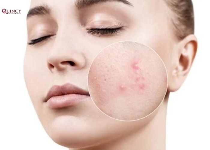 Những tác nhân nào có thể gây ra mụn? 6 những tác nhân nào có thể gây ra mụn