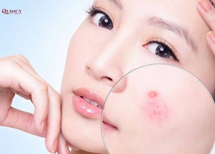 Những tác nhân nào có thể gây ra mụn? 7 những tác nhân nào có thể gây ra mụn