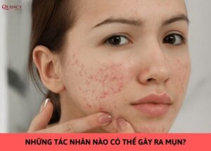 những tác nhân nào có thể gây ra mụn