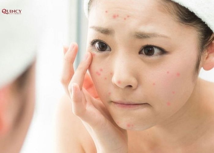 Những tác nhân nào có thể gây ra mụn? 8 những tác nhân nào có thể gây ra mụn
