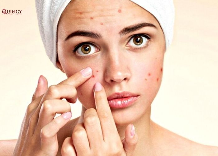 Những tác nhân nào có thể gây ra mụn? 9 những tác nhân nào có thể gây ra mụn