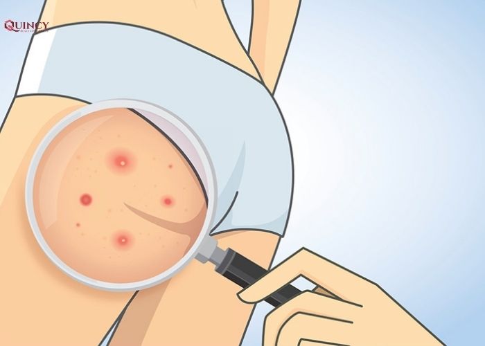 Nổi mụn ở mông do đâu? Cách điều trị hiệu quả 6 nổi mụn ở mông