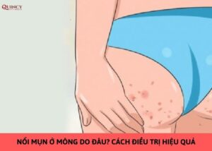 nổi mụn ở mông