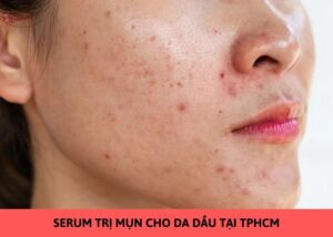 serum trị mụn ẩn cho da dầu tại tphcm