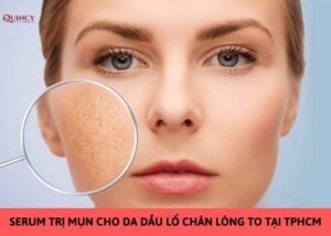 serum trị mụn cho da dầu lỗ chân lông to tại tphcm