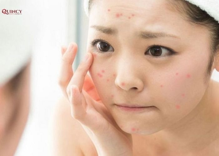Doctor Care - Serum trị mụn cho da nhạy cảm tại TPHCM 7 serum trị mụn cho da nhạy cảm tại tphcm