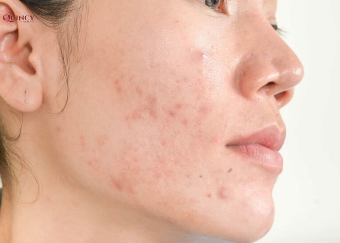 Doctor Care - Serum trị mụn cho da nhạy cảm tại TPHCM 11 serum trị mụn cho da nhạy cảm tại tphcm