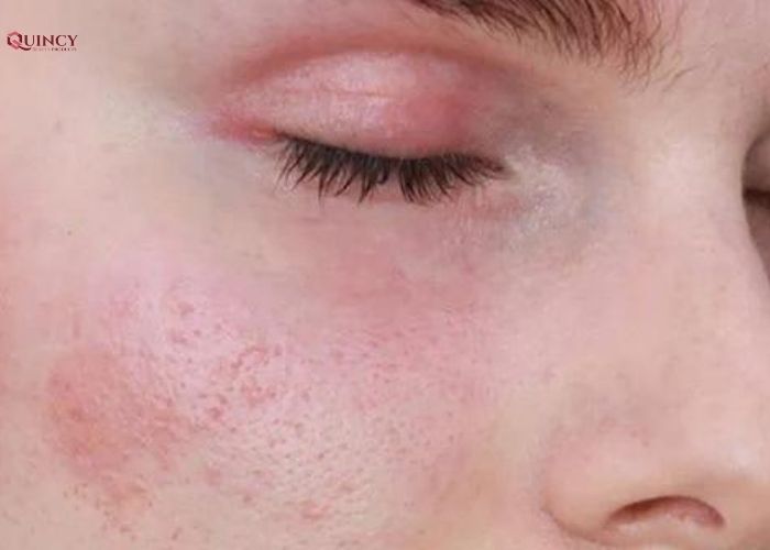 Doctor Care - Serum trị mụn cho da nhạy cảm tại TPHCM 8 serum trị mụn cho da nhạy cảm tại tphcm
