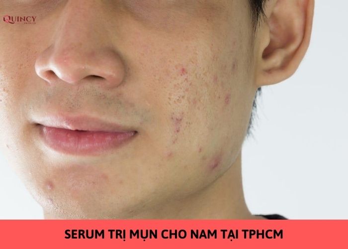 serum trị mụn cho nam tại tphcm