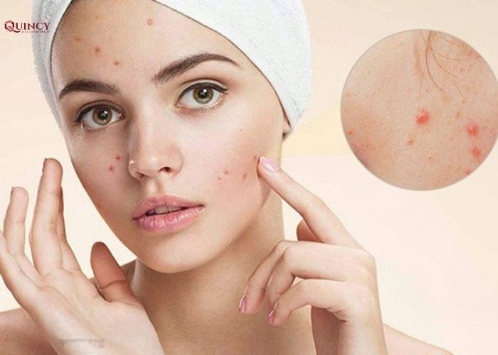 serum trị mụn hiệu quả tại tphcm