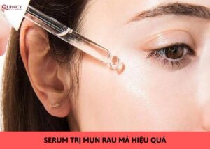 serum trị mụn rau má hiệu quả