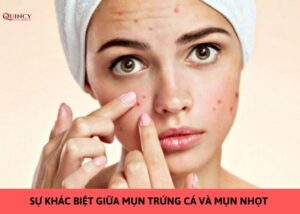 sự khác biệt giữa mụn trứng cá và mụn nhọt