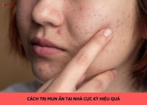 trị mụn ẩn tại nhà