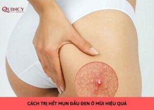 trị mụn mông
