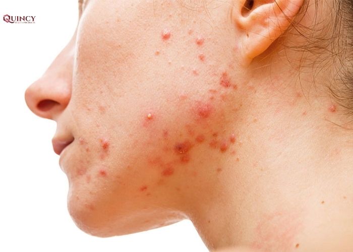 Bị mụn thời kỳ mãn kinh là gì? 9 bị mụn thời kỳ mãn kinh