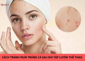 cách tránh mụn trứng cá sau khi tập luyện thể thao