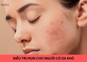 điều trị mụn cho người có da khô